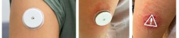 Picture of CGM Side Effects and How to Avoid Them - Not Just a Patch