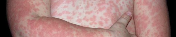 Image showcasing CGM Side Effects and How to Avoid Them - Not Just a Patch